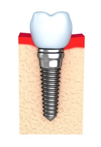 dental implants in milton keynes