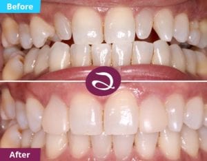 Composite Veneers Milton Keynes Used To Correct The Peg Shaped Lateral Incisors - Aspects Dental In Milton Keynes