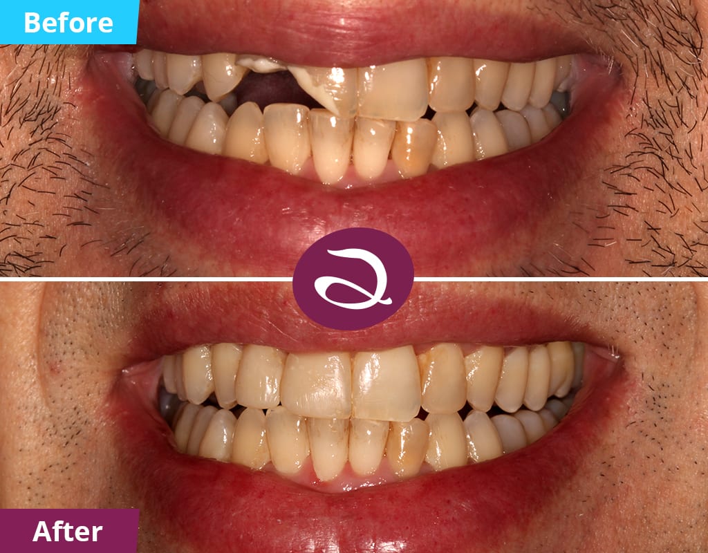 Broken Tooth Emergency Dentist Milton Keynes - Before And After Photos - Broken Teeth Composite Bonding