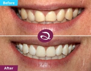 Teeth Whitening Milton Keynes Followed By Composite Veneers Milton Keynes - Aspects Dental In Milton Keynes