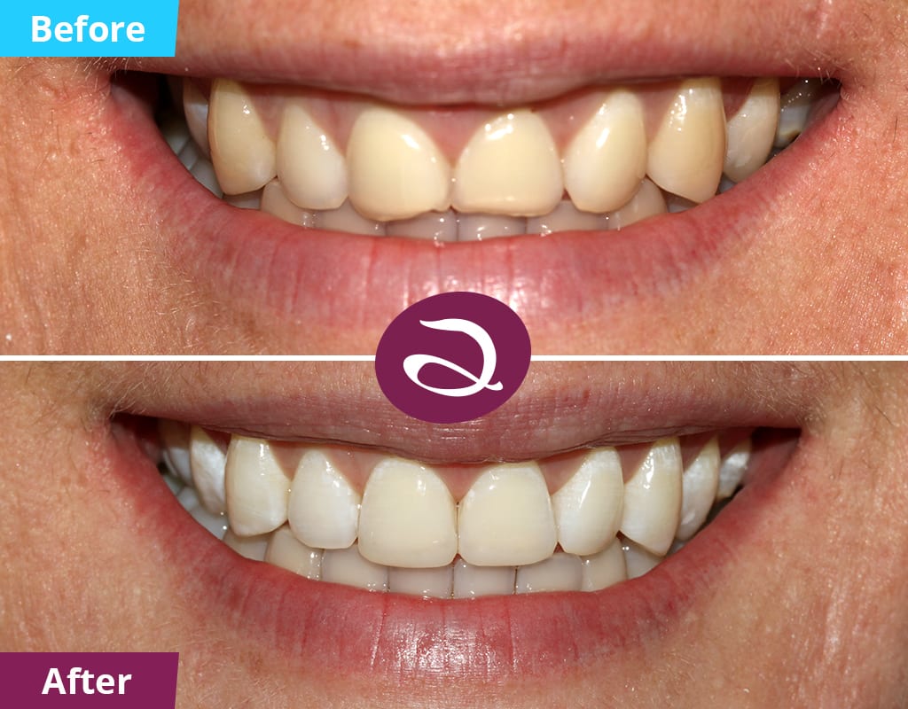 Cosmetic Dentistry Before And After From The Aspects Dental Clinic In Milton Keynes - Composite Veneers Milton Keynes