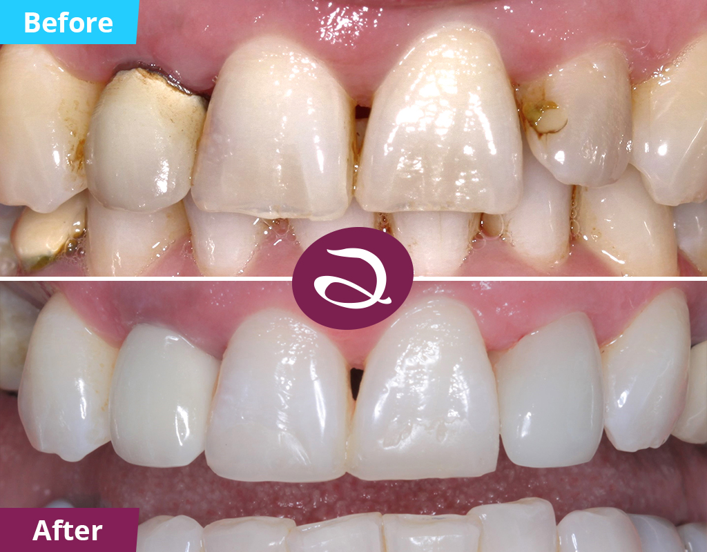 Cosmetic Dentistry Before And After From The Aspects Dental Clinic In Milton Keynes - Dental Crown Milton Keynes