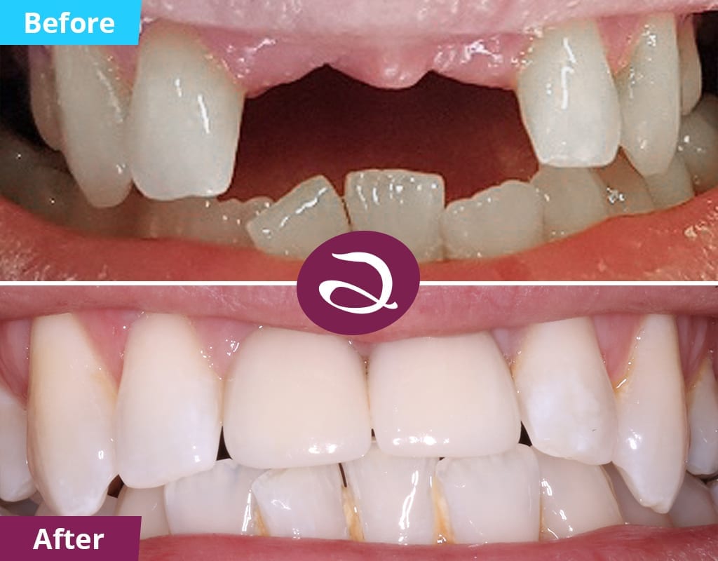 Cosmetic Dentistry Before And After From The Aspects Dental Clinic In Milton Keynes - Dental Implants Milton Keynes