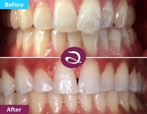 Cosmetic Dentistry Before And After From The Aspects Dental Clinic In Milton Keynes - Teeth Straightening Milton Keynes