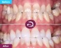 Cosmetic Dentistry Before And After From Aspects Dental In Milton Keynes