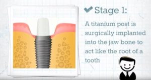 What Are Dental Implants - Stage 1 - Dental Implants Milton Keynes - Aspects Dental Clinic Milton Keynes