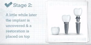 What Are Dental Implants - Stage 2 - Dental Implants Milton Keynes - Aspects Dental Clinic Milton Keynes