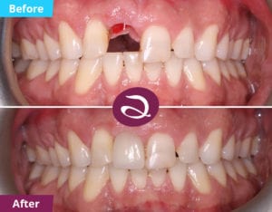 Dental Implants Milton Keynes - Front Tooth Implant - Aspects Dental In Milton Keynes