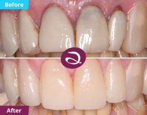 Front Porcelain Veneers Milton Keynes To Replace Old Chipped Veneers - Aspects Dental In Milton Keynes