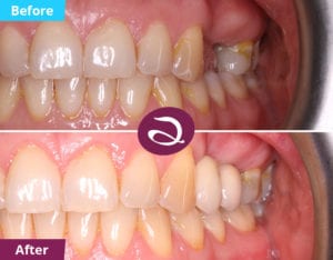 Dental Implants Milton Keynes - Dental Implants Before And After Photos
