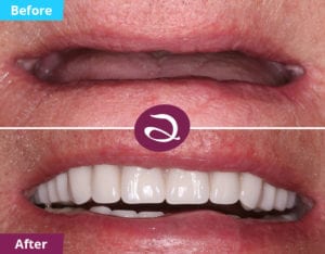 Dentures Milton Keynes - Dentures Before And After Photos