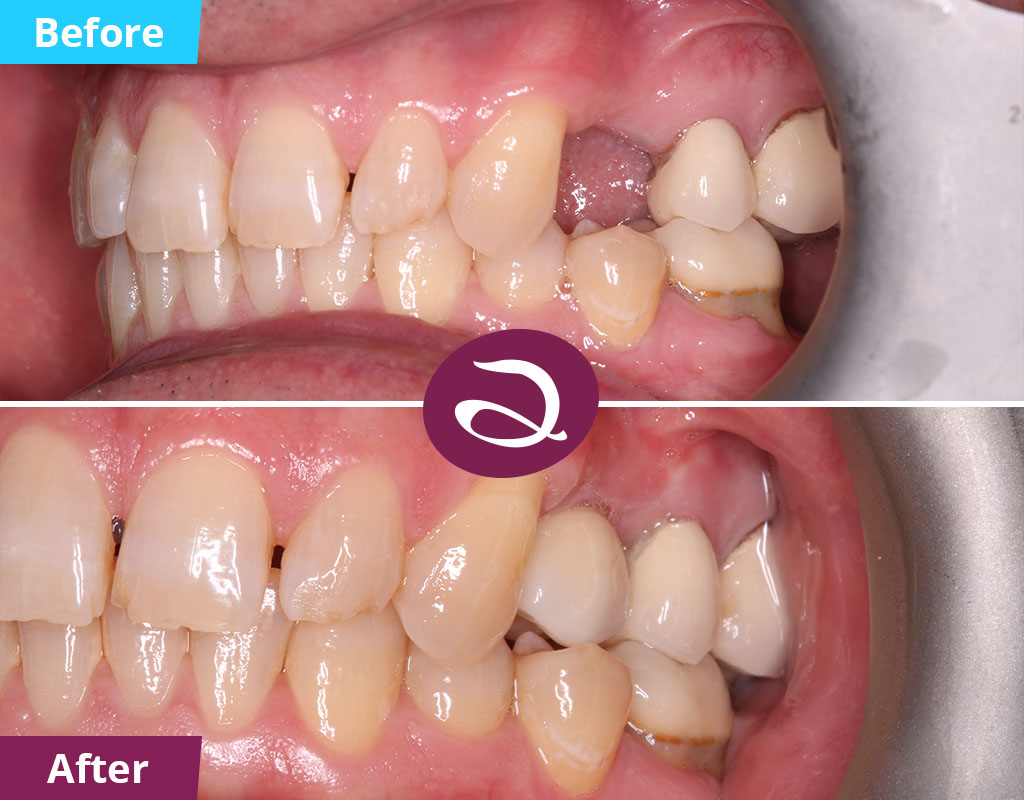 Dental Implants Milton Keynes - Dental Implants Before And After Photos
