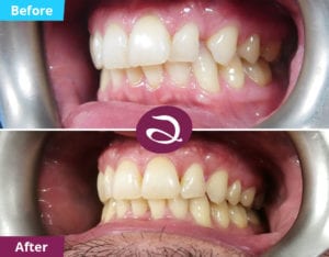 Milton Keynes Dentist Launches Invisalign Special Offer - Invisalign Before And After Photos From Aspects Dental In Milton Keynes