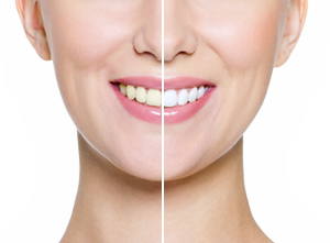 Teeth Whitening Bletchley - Boutique Teeth Whitening & Enlighten Teeth Whitening From Aspects Dental In Milton Keynes