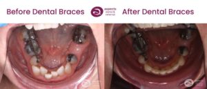 Jane Irwin - Lower Teeth Straightening Milton Keynes - Dental Braces Before And After Photos 1 From Aspects Dental In Milton Keynes