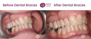 Jane Irwin - Lower Teeth Straightening Milton Keynes - Dental Braces Before And After Photos 2 From Aspects Dental In Milton Keynes