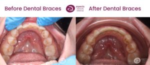 Miss W - Lower Teeth Straightening Milton Keynes - Dental Braces Before And After Photos From Aspects Dental In Milton Keynes