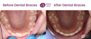 Miss W - Upper Teeth Straightening Milton Keynes - Dental Braces Before And After Photos From Aspects Dental In Milton Keynes