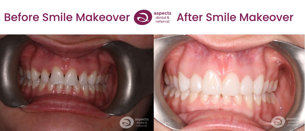 Hannah Richards - Smile Makeover Milton Keynes - Smile Makeover Before And After Photos 2 From Aspects Dental In Milton Keynes