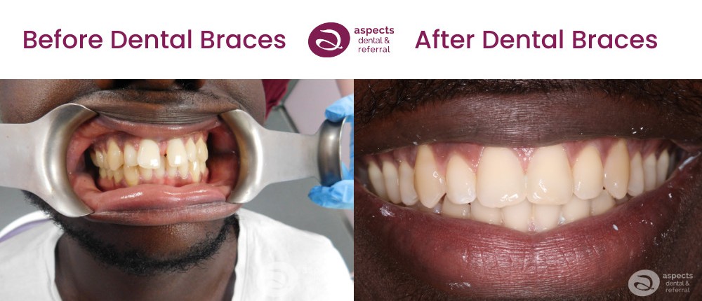 Wil - Lower & Upper Teeth Straightening Milton Keynes - Metal Dental Braces Before & After Photos 1 - Aspects Dental Milton Keynes