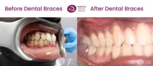 Wil - Lower & Upper Teeth Straightening Milton Keynes - Metal Dental Braces Before & After Photos 2 From Aspects Dental In Milton Keynes
