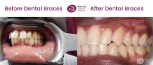 Wil - Lower & Upper Teeth Straightening Milton Keynes - Metal Dental Braces Before & After Photos 3 From Aspects Dental In Milton Keynes