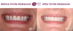 Milton Keynes Dentist Completes Smile Makeover Using Fixed Dental Braces, Teeth Whitening & Composite Bonding