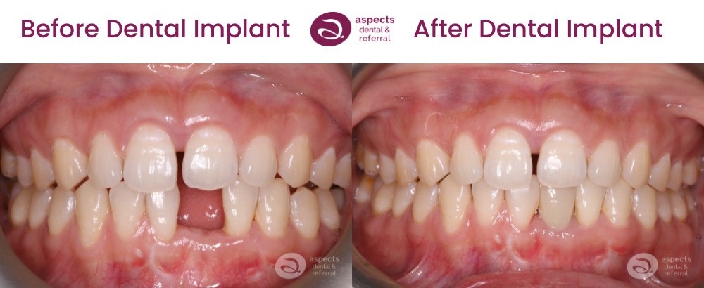 Milton Keynes Implant Dentist Completes Single Dental Implant & Sinus Lift - Single Dental Implant Before And After Photos