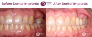 Milton Keynes Implant Dentist Completes Upper And Lower Dental Implants - Upper Dental Implants Before And After Photos