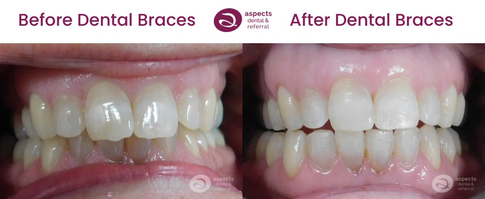 Milton Keynes Orthodontist Dental Braces Offer For June 2022 - Before And After Dental Braces Photos