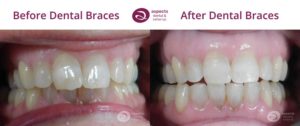 Milton Keynes Dentist Monthly Email Newsletter July 2022 - Dental Braces Offer July 2022 (10% Off) - Dental Braces Before & After