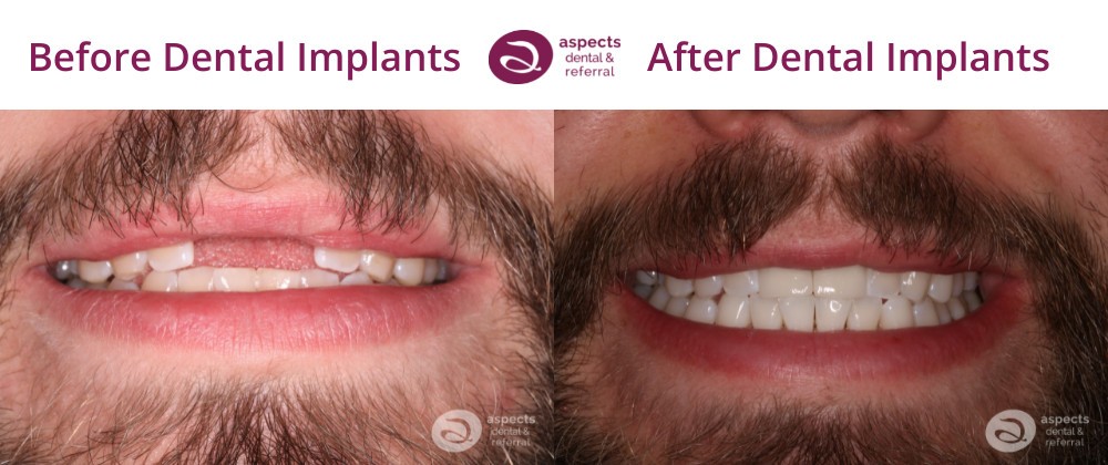 Milton Keynes Dentist Monthly Email Newsletter July 2022 - Treatment Of The Month - Dental Implants Before And After Photos