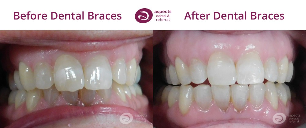 Milton Keynes Dentist Monthly Email Newsletter August 2022 - Dental Braces Offer August 2022 (10% Off) - Dental Braces Before & After