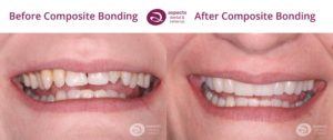Milton Keynes Dentist Monthly Email Newsletter August 2022 - Treatment Of The Month - Composite Bonding Before And After Photos