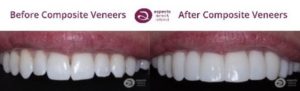 Milton Keynes Dentist Monthly Email Newsletter September 2022 - Treatment Of The Month - Composite Veneers Before And After Photos