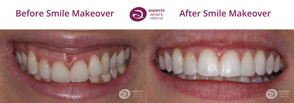Milton Keynes Dentist Monthly Email Newsletter October 2022 - Treatment Of The Month - Smile Makeover Before And After Photos