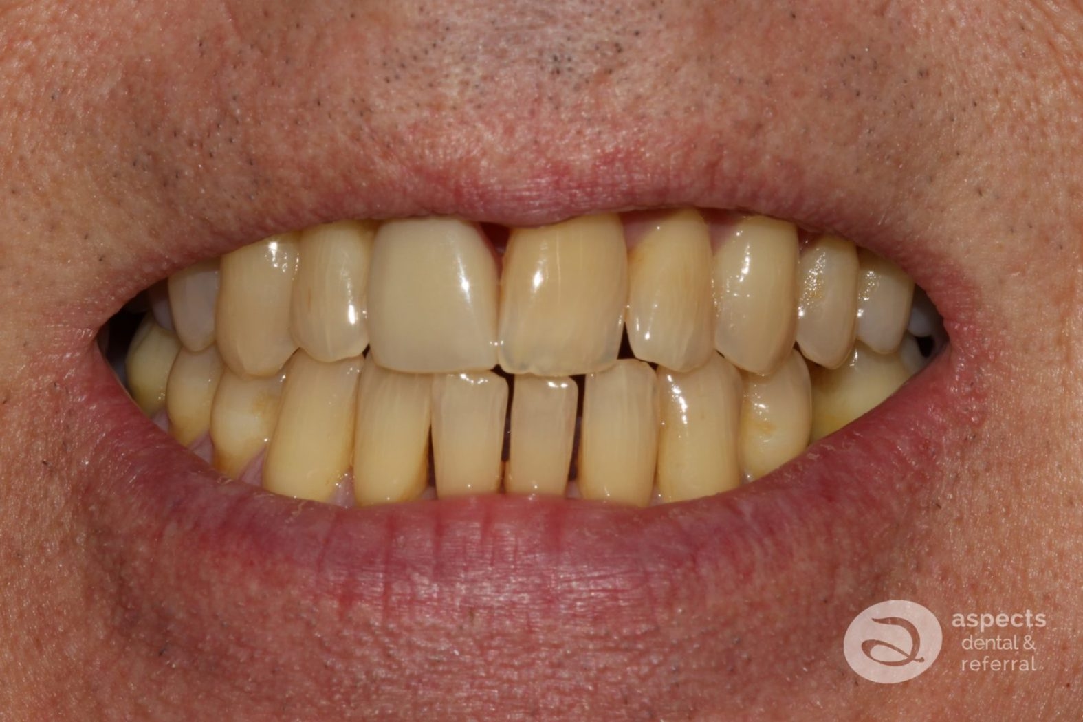 Treatment Of The Month - Existing Single Tooth Denture & Discoloured Teeth Before Photo - November 2022 Email Newsletter