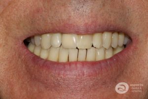 Treatment Of The Month - New Dental Bridge & Treatment Completed After Photo - November 2022 Email Newsletter
