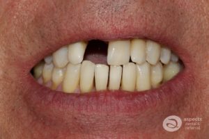 Treatment Of The Month - Single Tooth Denture Removed & Teeth Whitening Completed Photo - November 2022 Email Newsletter