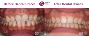 Milton Keynes Dentist Email Newsletter Orthodontic Open Day January 2023 - Dental Braces Before And After Photos