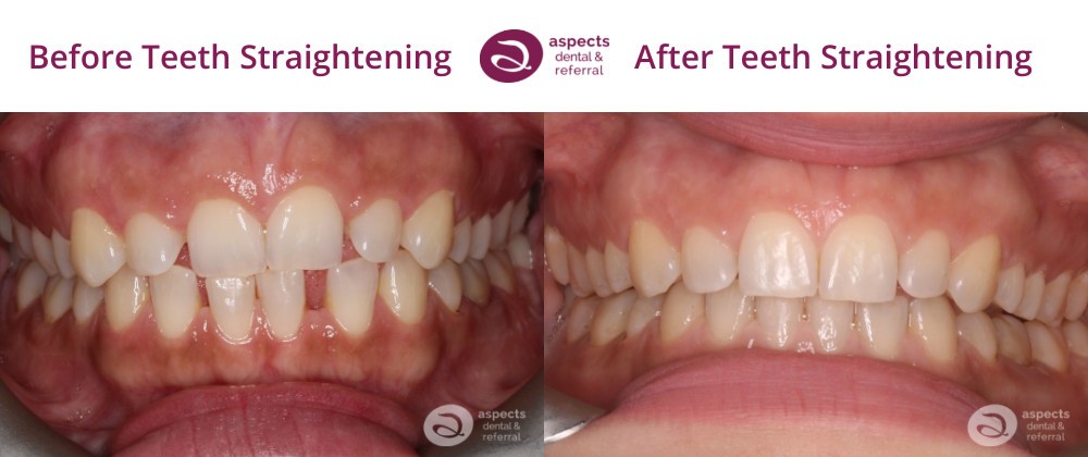 Milton Keynes Dentist Monthly Email Newsletter Jan 2023 - Orthodontic Open Day Jan 2023 - Teeth Straightening Before & After Photos