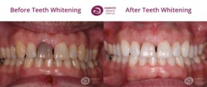 Milton Keynes Dentist Monthly Email Newsletter January 2023 - Teeth Whitening Special Offer - Save £50