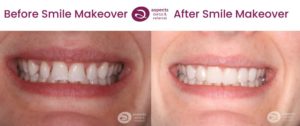 Milton Keynes Dentist Completes Smile Makeover Using Fixed Dental Braces, Teeth Whitening & Composite Bonding