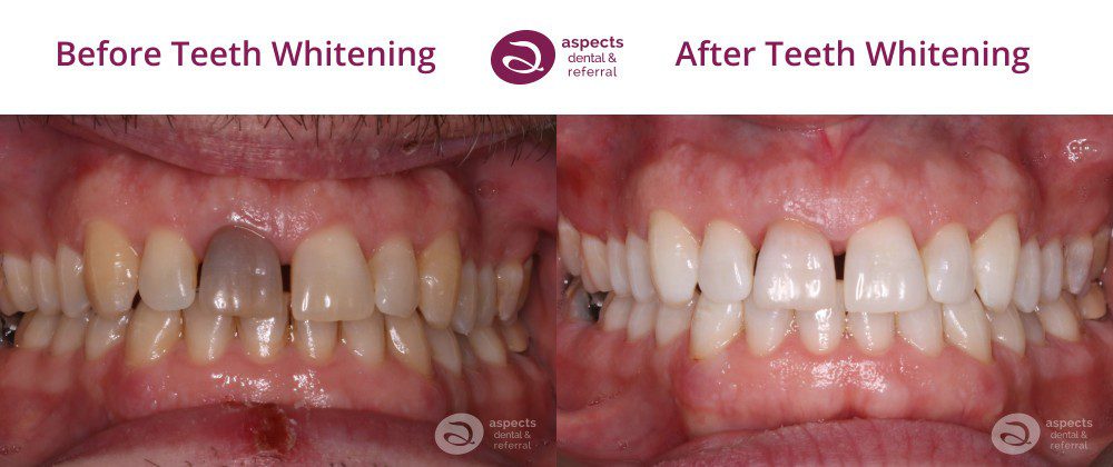 Teeth Whitening Aylesbury - Teeth Whitening Before And After Photos - Aspects Dental In Milton Keynes