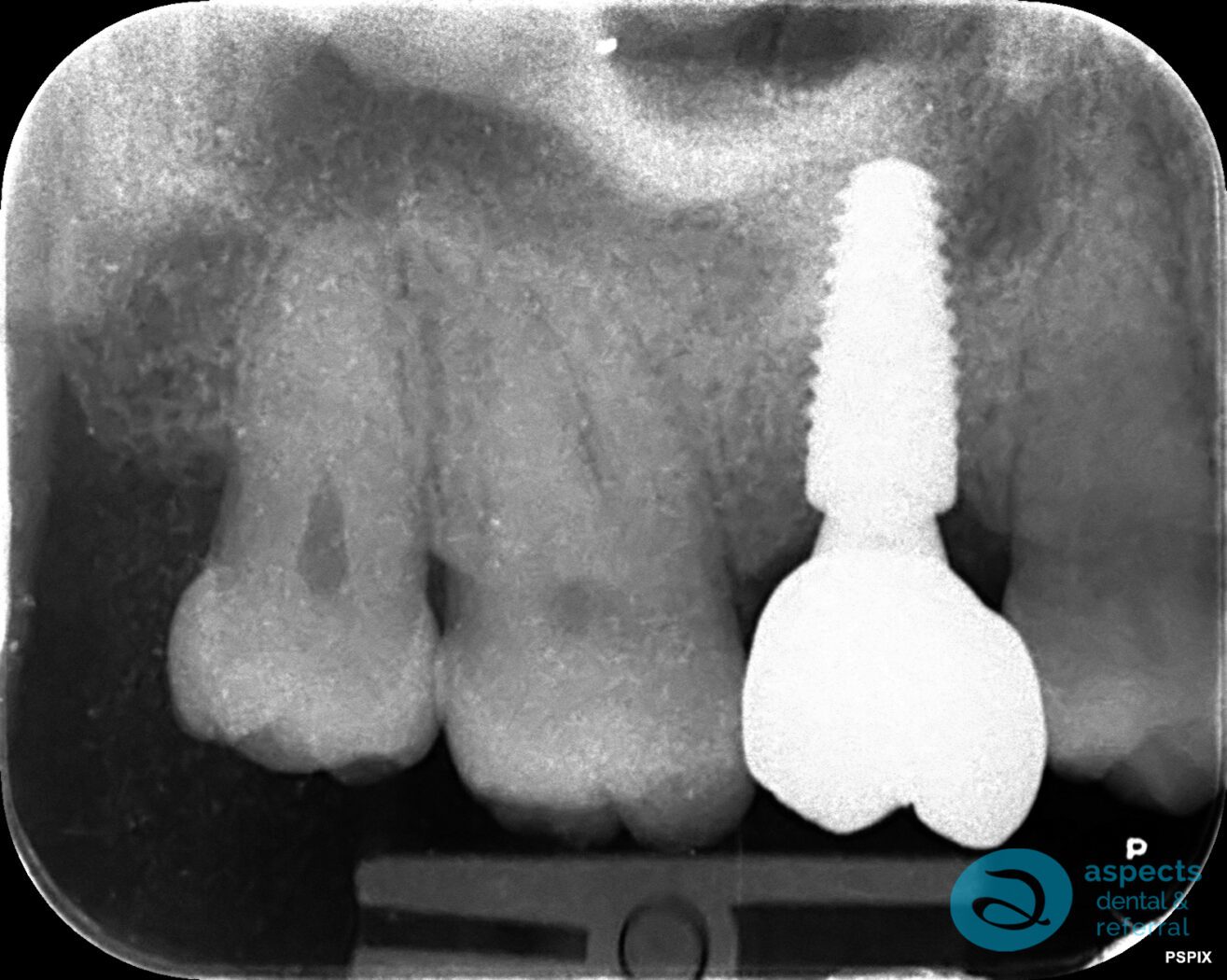 After Dental Implant Photo - Dental Implants Milton Keynes - Aspects Dental Case Study 4-2