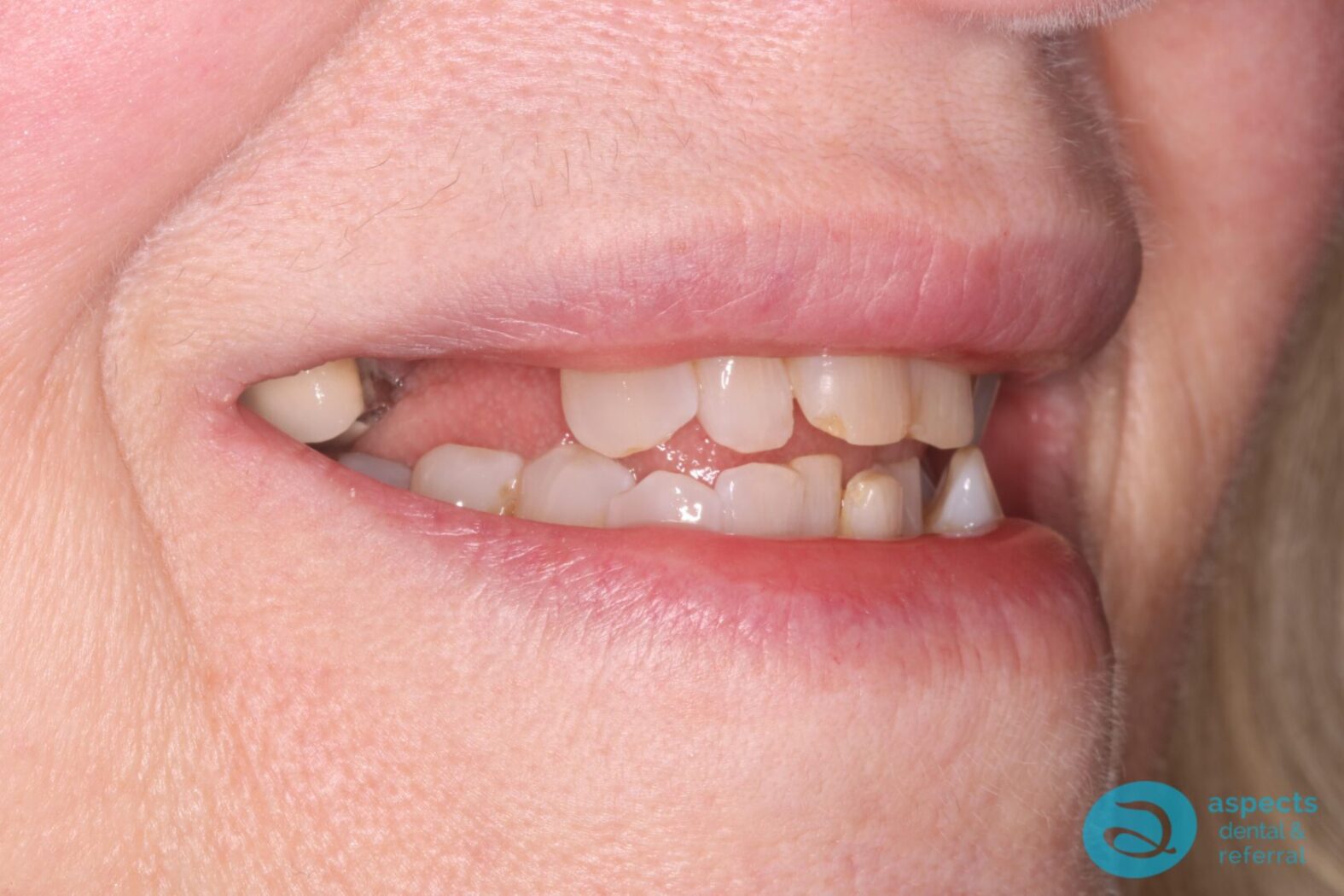 Before Dental Implant Photo - Dental Implants Milton Keynes - Aspects Dental Case Study 2