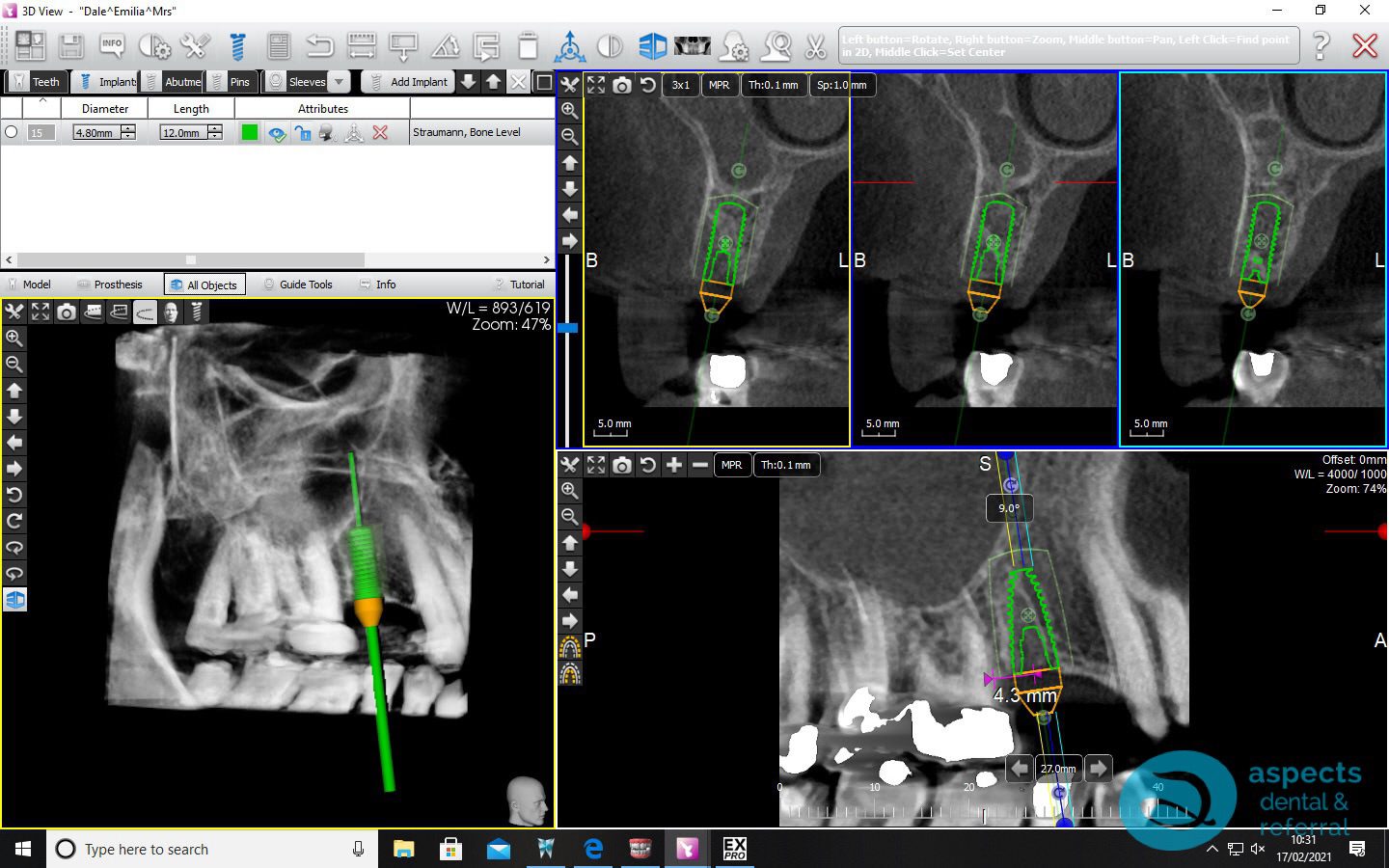 Before Dental Implant Planning - Dental Implants Milton Keynes - Aspects Dental Case Study 2