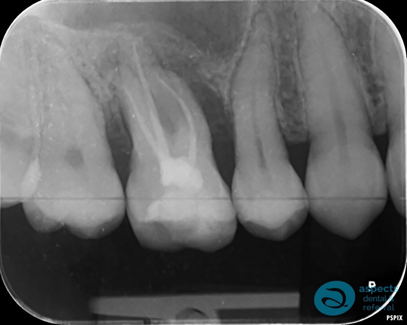 Before Extraction & Implant Photo - Dental Implants Milton Keynes - Aspects Dental Case Study 4-2