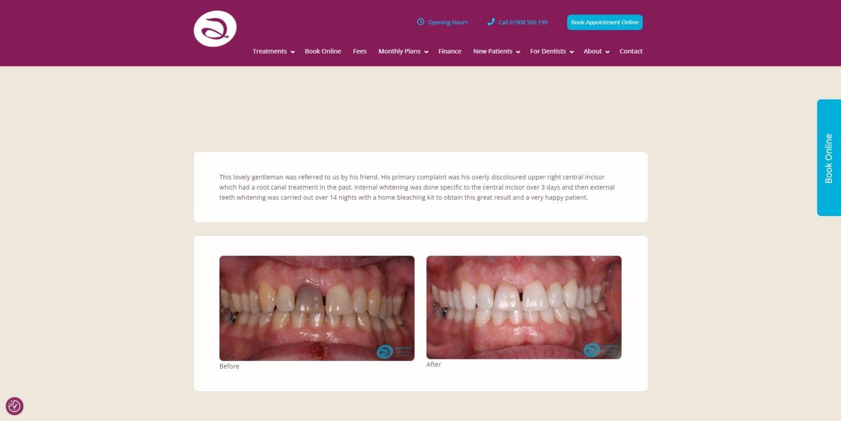 Milton Keynes Dentist Launches New Cosmetic Dentist Before And After Gallery - Teeth Whitening Before And After Photo