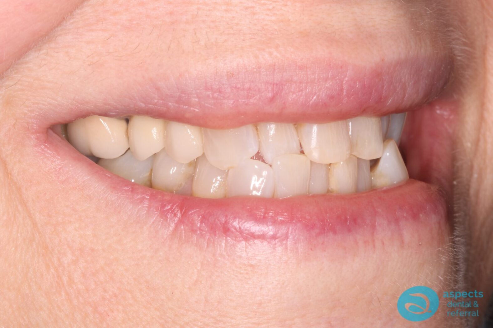 After Dental Implant Photo - Dental Implants Milton Keynes - Aspects Dental Case Study 2